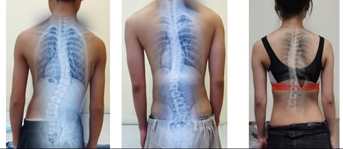 青少年脊柱侧弯康复治疗 评估、诊断与治疗思路全面剖析